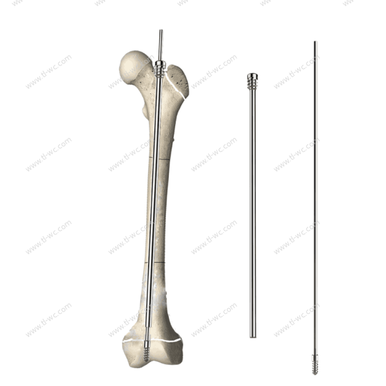 Telescopic Intramedullary Nail